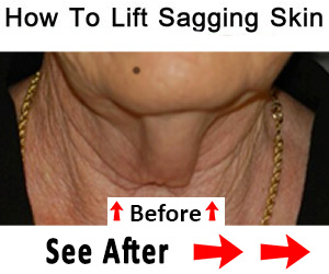 Doctor: How To Lift A Saggy Neck and Arms