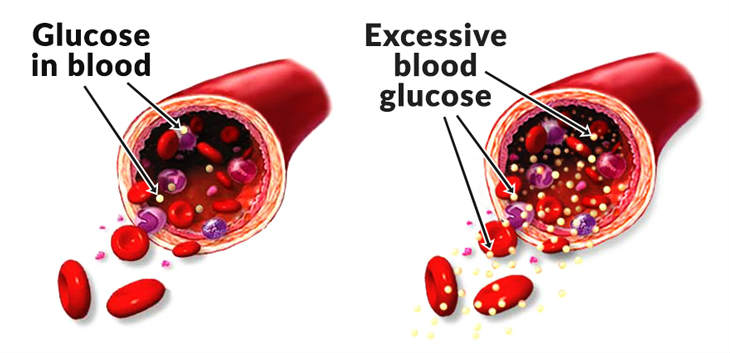 High Blood Sugar? How To Keep Blood Sugar Level Under Control