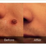 skincell-pro-skintag-removal