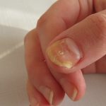 nail-fungus-fingernail-treatment