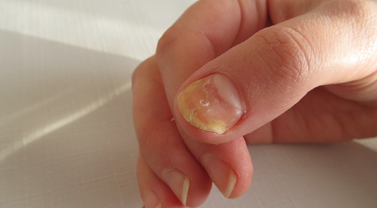 How to Get Rid of Fingernail Fungus - Healthy Living Products Reviews