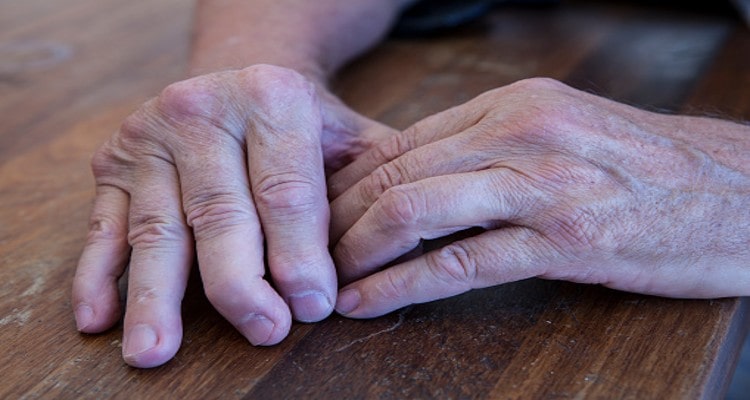 Psoriatic Arthritis Symptoms and Signs