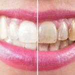 best-in-home-teeth-whitening