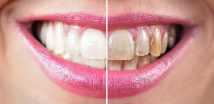 best in home teeth whitening