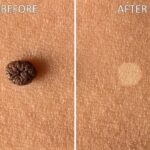 skin-tag-remover-repair-cream