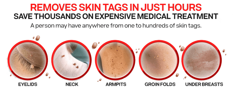 Best Way To Remove Skin Tags – Advanced Skin Tags Removal, Remove Tags in less Than Six Hours