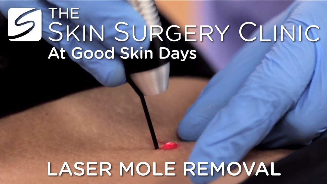 How Much Does it Cost to Get a Mole Removed and skin tags