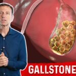 Video Thumbnail: What is a Gallbladder Attack? – Symptoms & Causes Covered by Dr.Berg