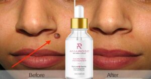 amarose skin care - amarose skin tag remover
